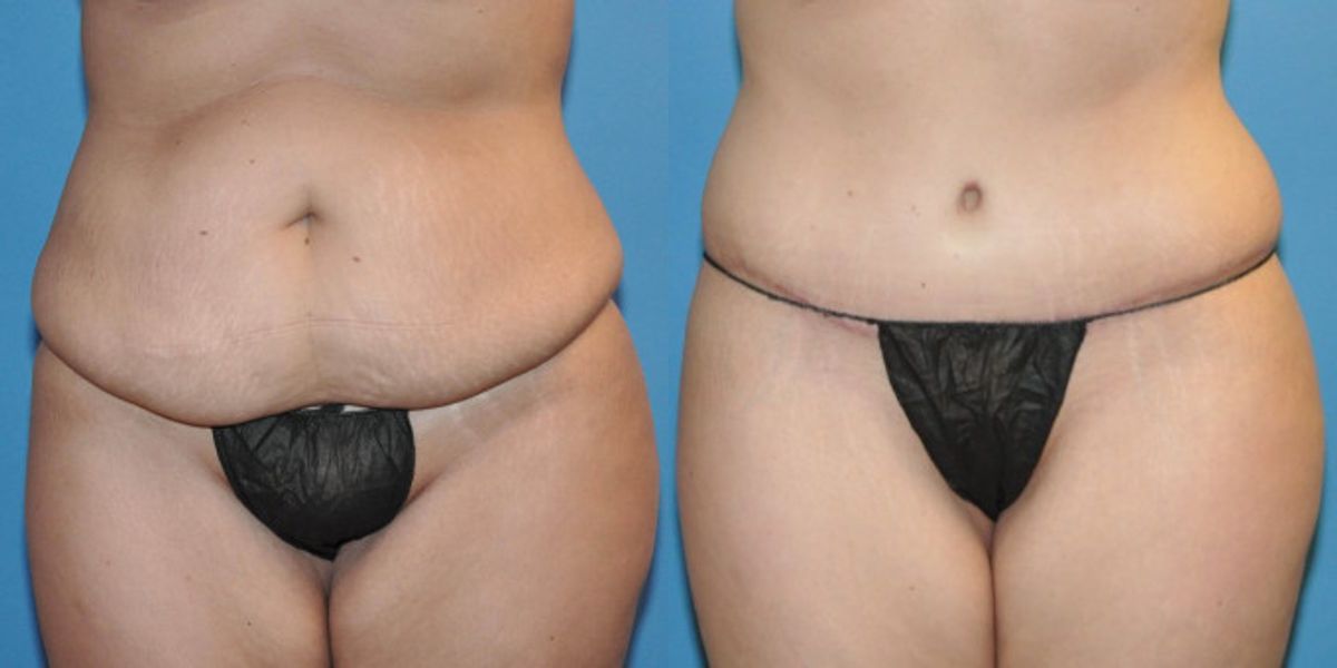 Tummy Tuck #19 - Before and After