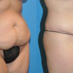 Tummy Tuck #19 - Before and After