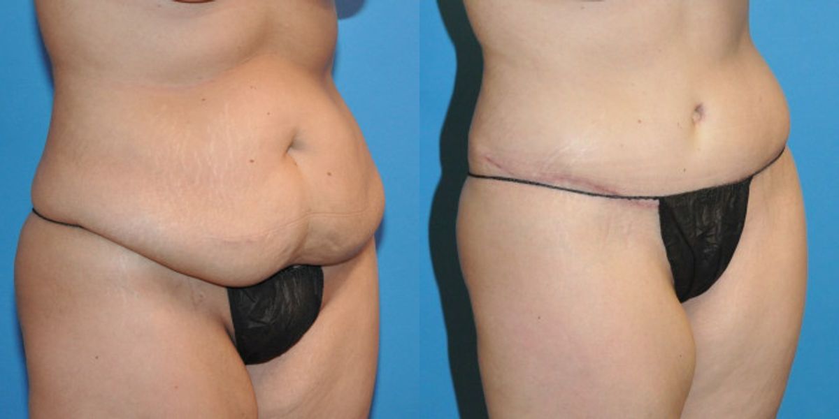 Tummy Tuck #19 - Before and After