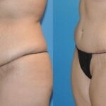Tummy Tuck #19 - Before and After