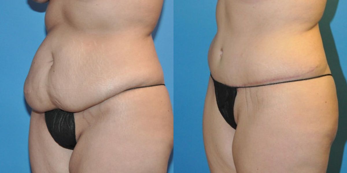 Tummy Tuck #19 - Before and After