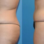 Tummy Tuck #19 - Before and After
