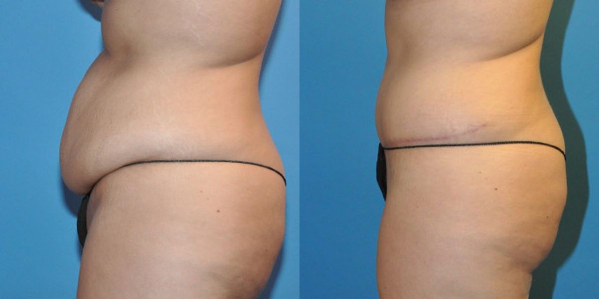Tummy Tuck #19 - Before and After