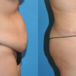 Tummy Tuck #19 - Before and After