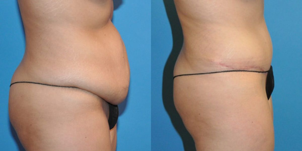 Tummy Tuck #19 - Before and After