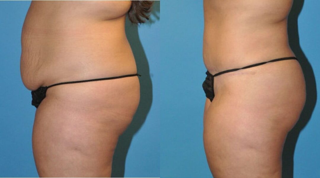 Tummy Tuck #20