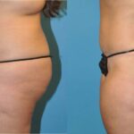 Tummy Tuck #20 - Before and After