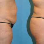 Tummy Tuck #20 - Before and After