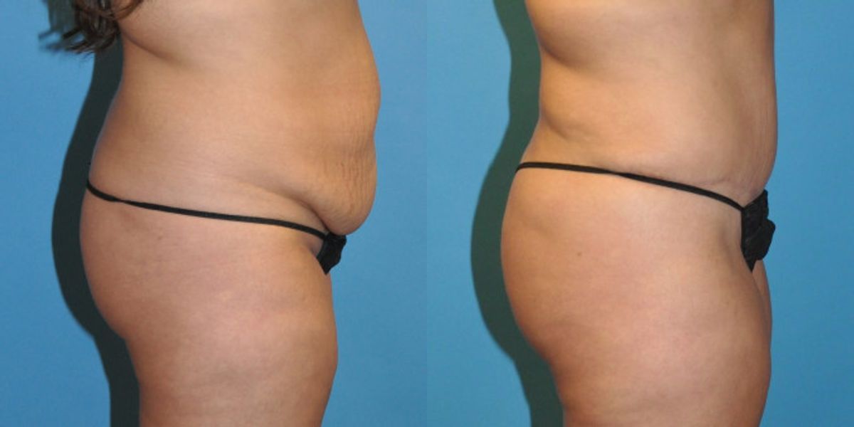 Tummy Tuck #20 - Before and After