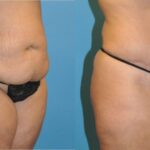 Tummy Tuck #20 - Before and After