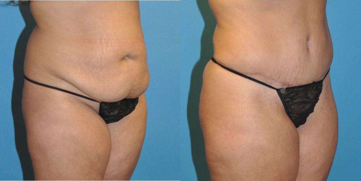 Tummy Tuck #20 - Before and After