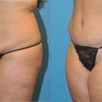 Tummy Tuck #20 - Before and After
