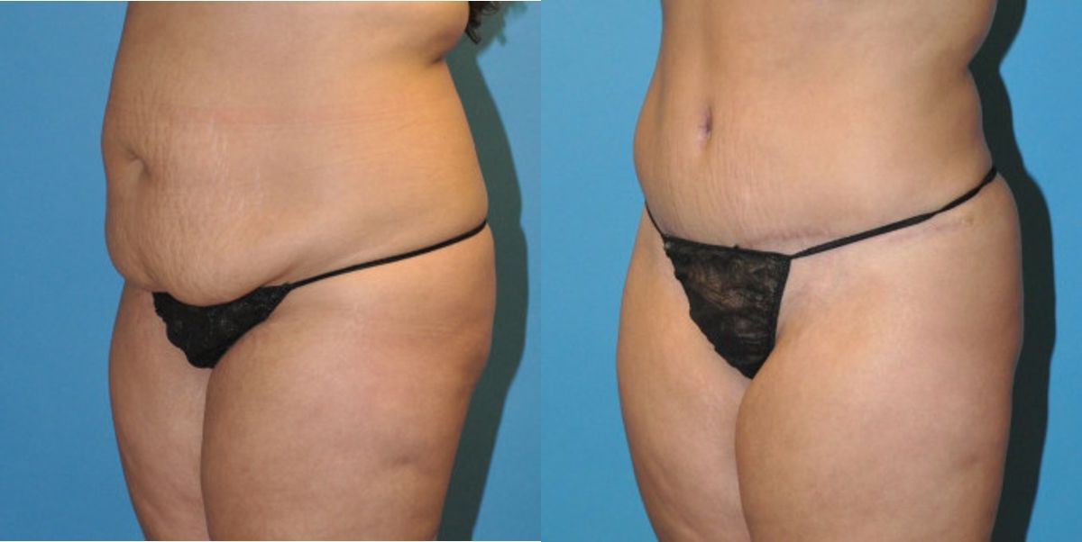 Tummy Tuck #20 - Before and After