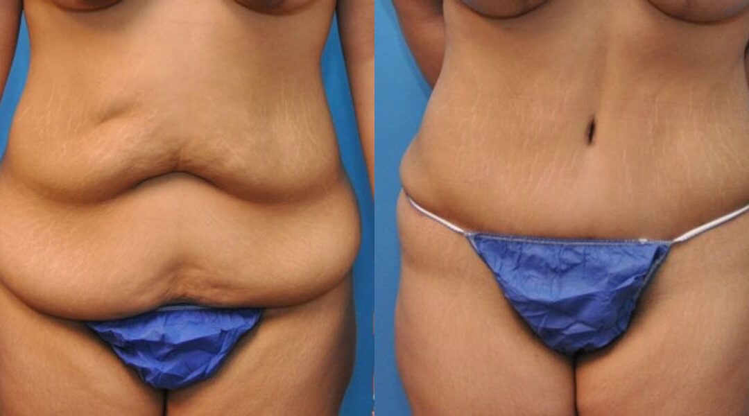 Tummy Tuck #21