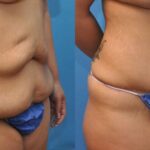 Tummy Tuck #21 - Before and After