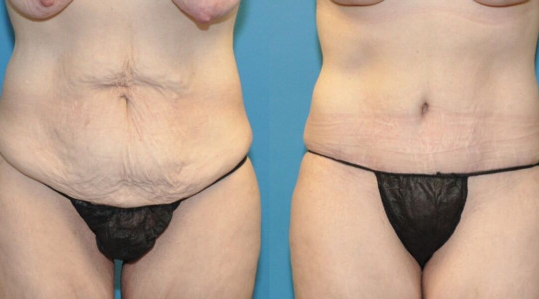 Tummy Tuck #22