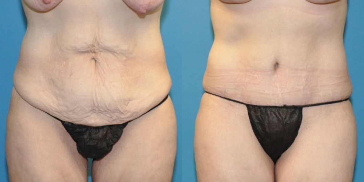 Tummy Tuck #22 - Before and After