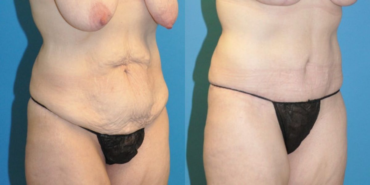 Tummy Tuck #22 - Before and After