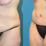 Tummy Tuck #22 - Before and After