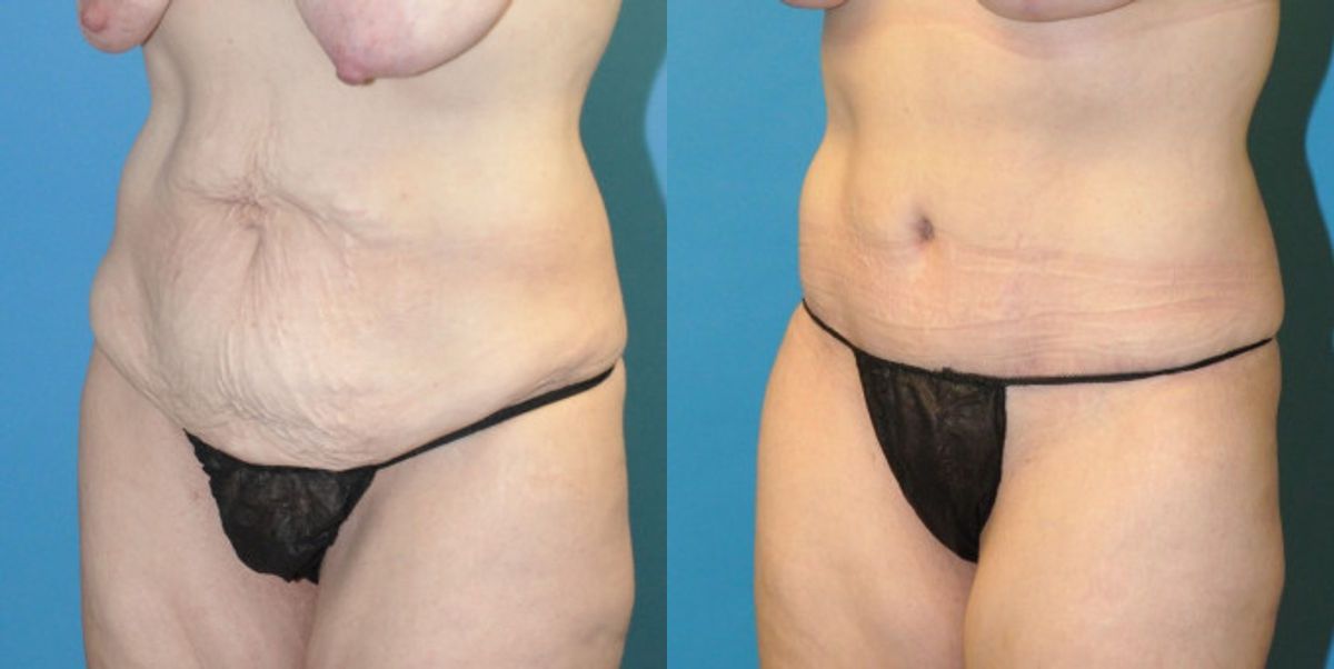Tummy Tuck #22 - Before and After