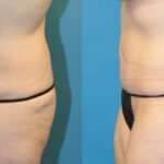 Tummy Tuck #22 - Before and After