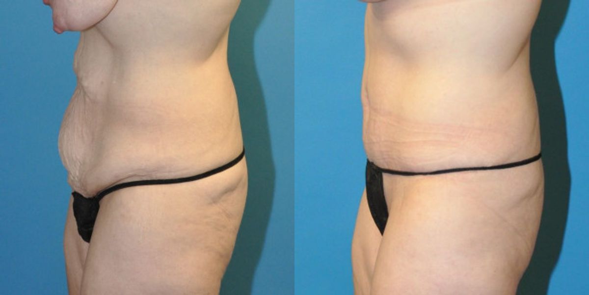 Tummy Tuck #22 - Before and After