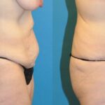 Tummy Tuck #22 - Before and After