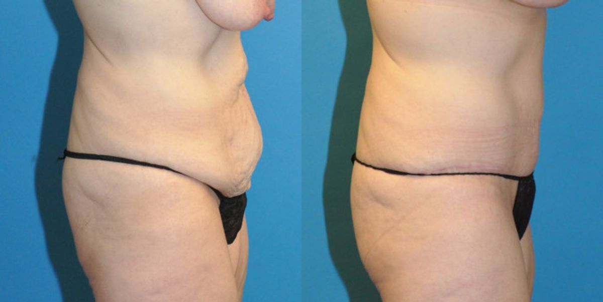 Tummy Tuck #22 - Before and After