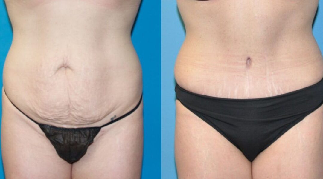 Tummy Tuck #23