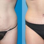 Tummy Tuck #23 - Before and After