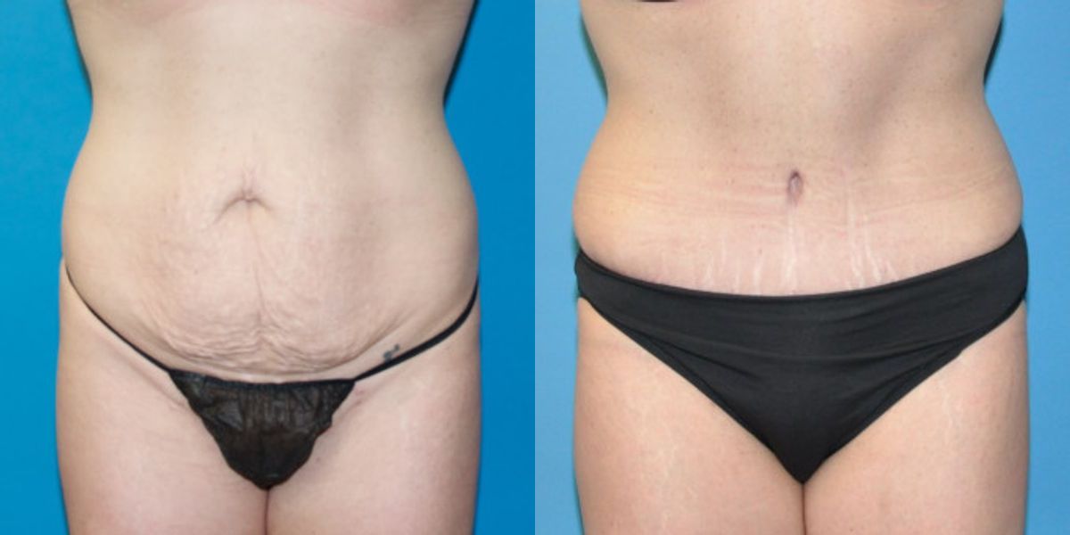 Tummy Tuck #23 - Before and After
