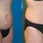 Tummy Tuck #23 - Before and After
