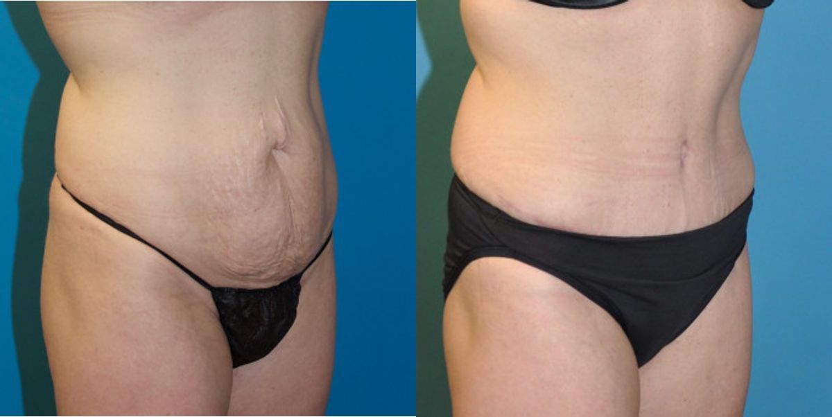 Tummy Tuck #23 - Before and After