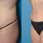 Tummy Tuck #23 - Before and After