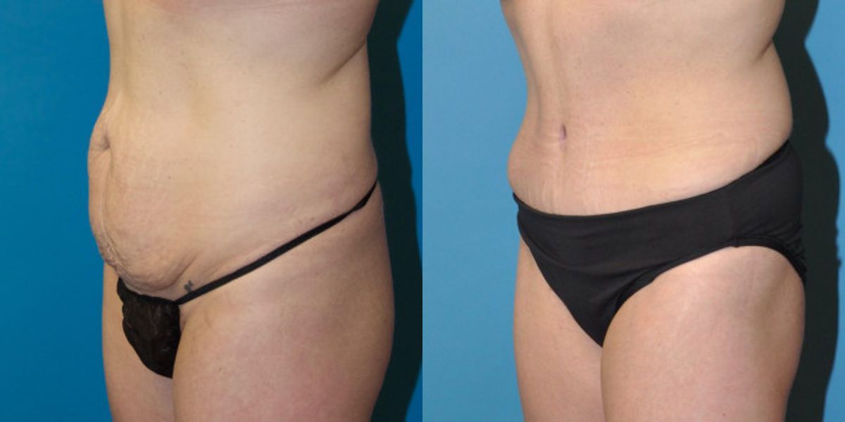 Tummy Tuck #23 - Before and After