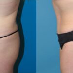 Tummy Tuck #23 - Before and After