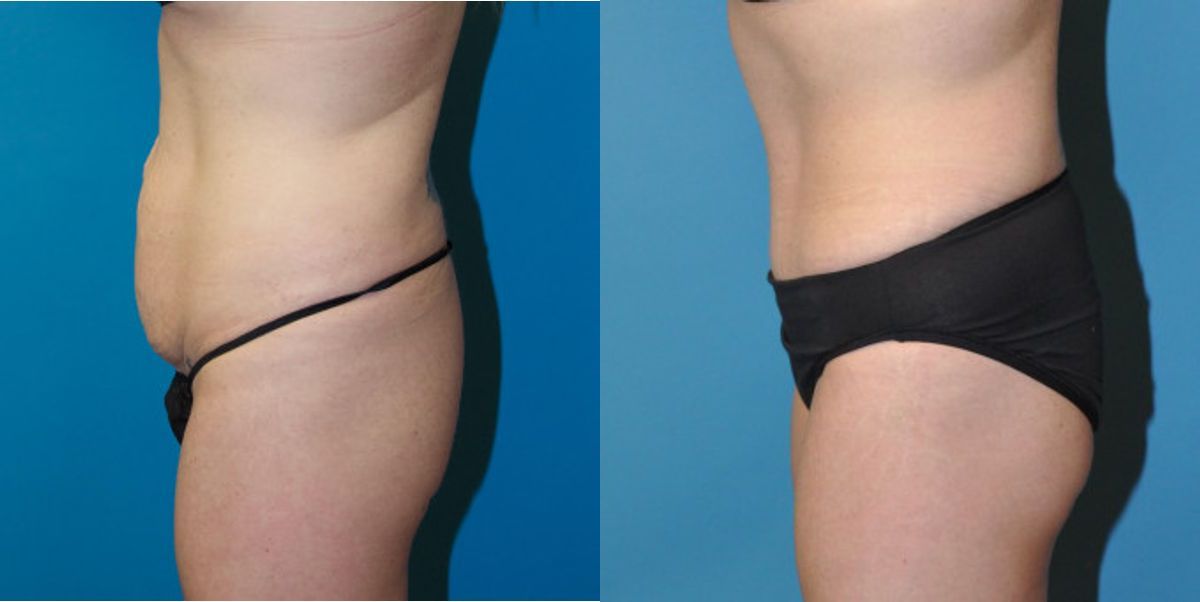 Tummy Tuck #23 - Before and After