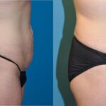 Tummy Tuck #23 - Before and After
