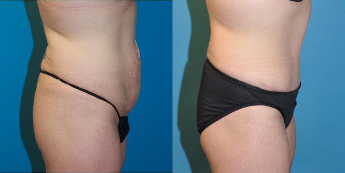 Tummy Tuck #23 - Before and After