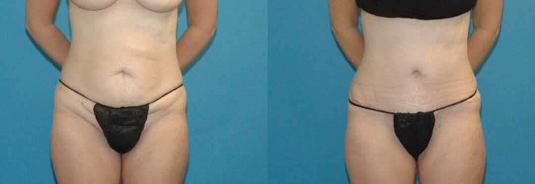 Tummy Tuck #24
