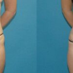 Tummy Tuck #24 - Before and After