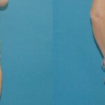 Tummy Tuck #24 - Before and After