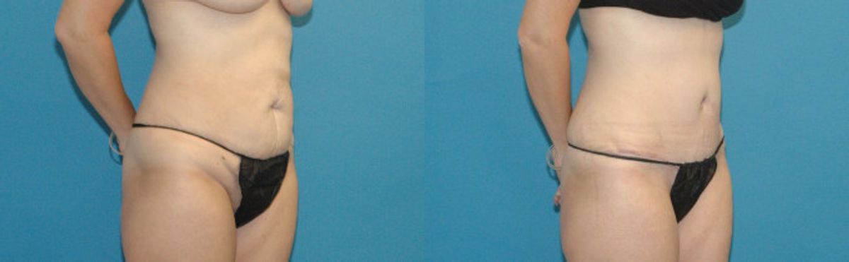 Tummy Tuck #24 - Before and After