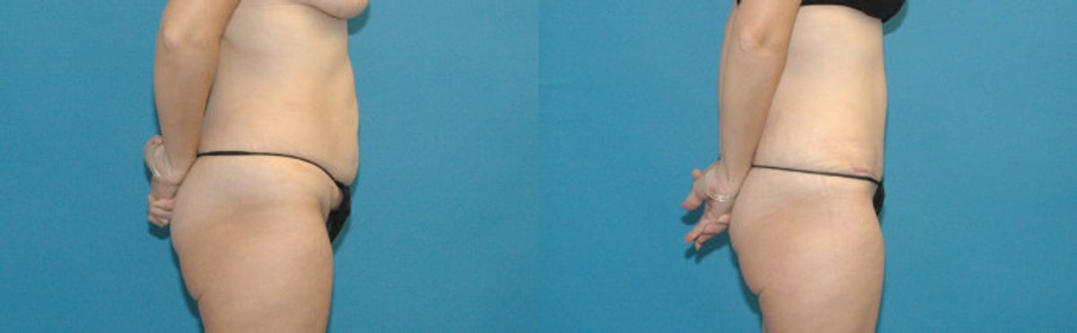 Tummy Tuck #24 - Before and After