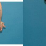 Tummy Tuck #24 - Before and After