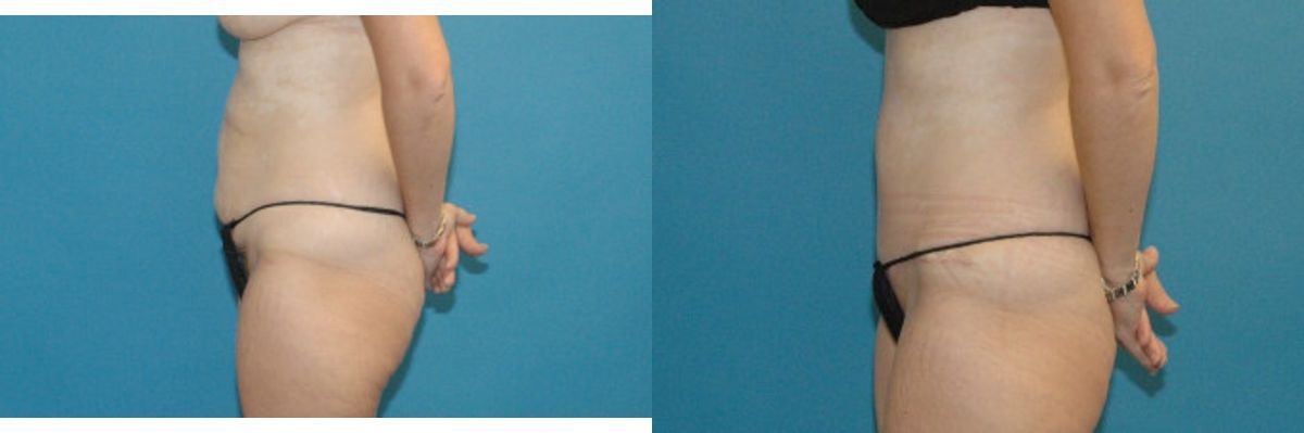 Tummy Tuck #24 - Before and After