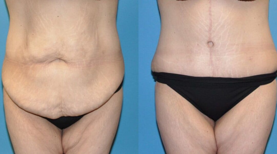 Tummy Tuck #25