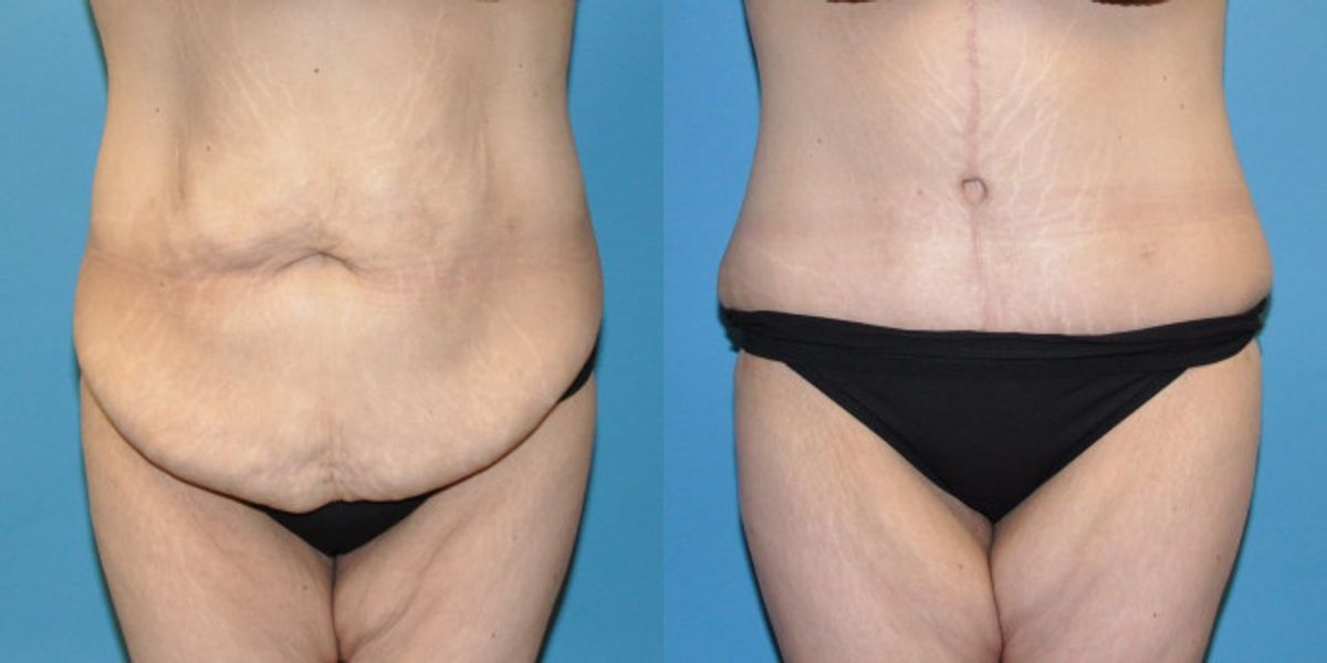 Tummy Tuck #25 - Before and After