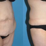 Tummy Tuck #25 - Before and After