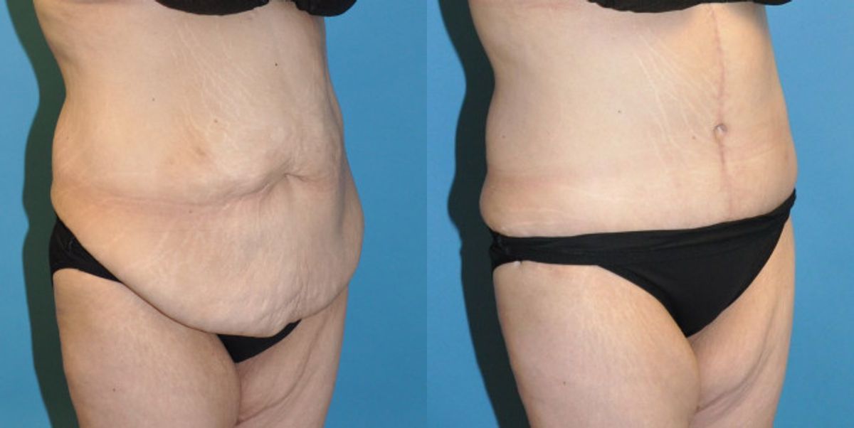 Tummy Tuck #25 - Before and After